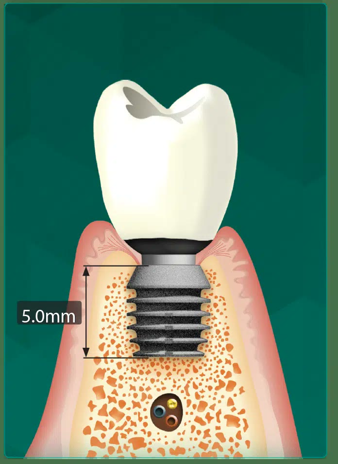 Dental implants